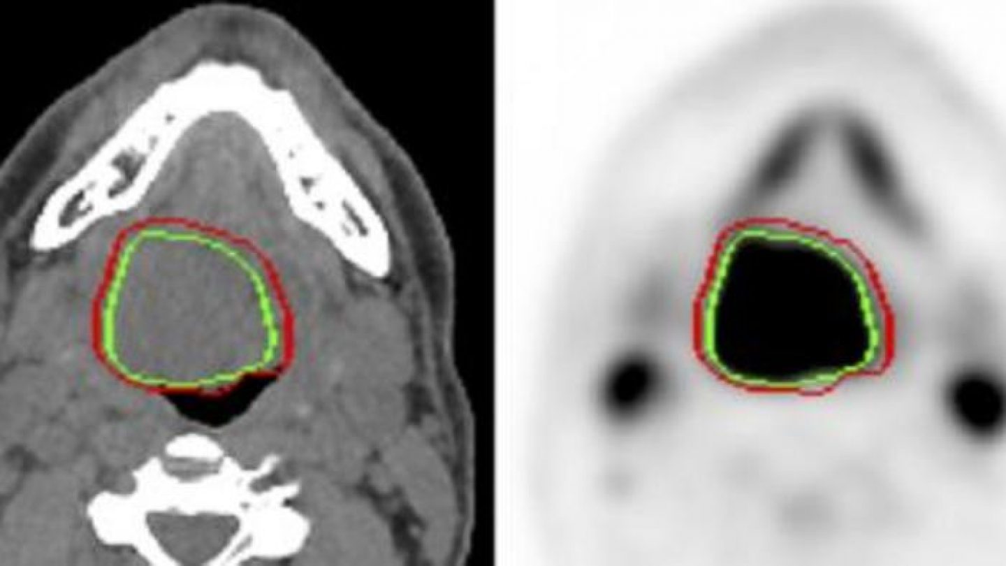 Des IA de détection automatique de tumeurs s’affrontent en compétition